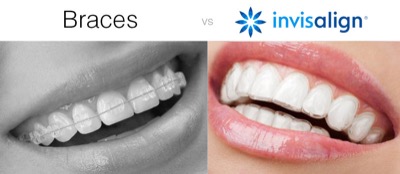 Invisalign voor en na foto's