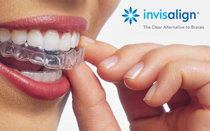 Invisalign beugel Etten-Leur